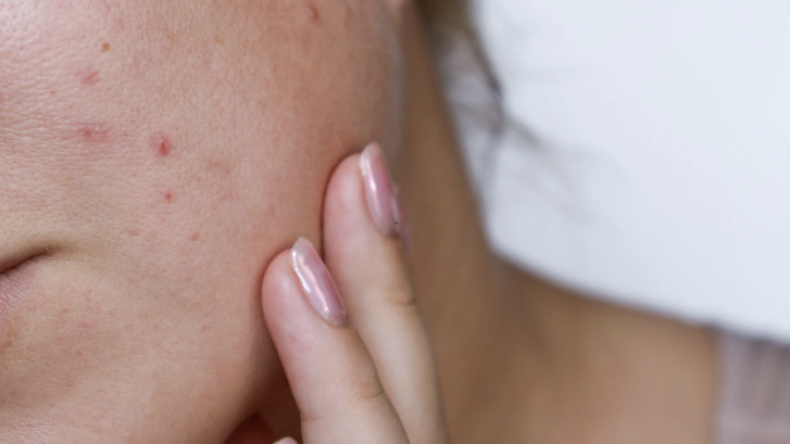 Acne Scar Treatment Options Near Hollywood Maryland